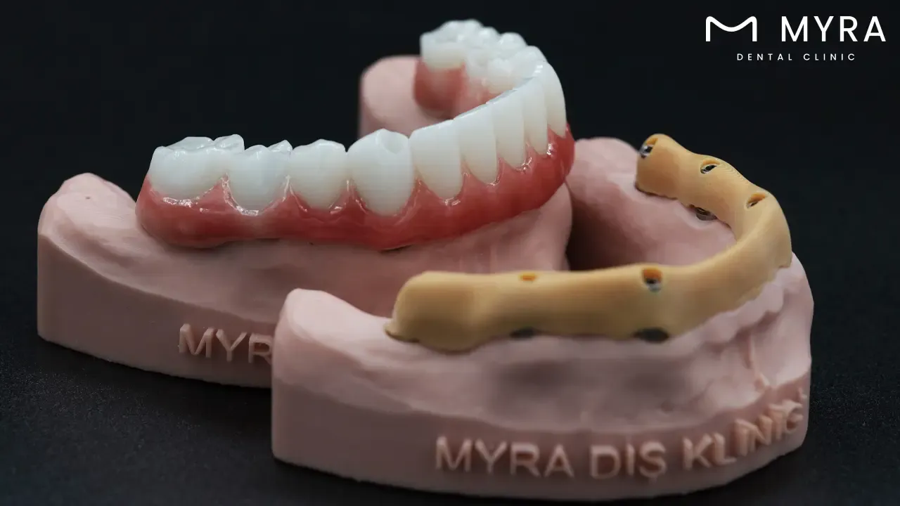 How does the jaw structure influence the maximum number of dental implants_.webp